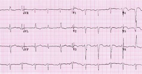 ventricular aneurysm ecg